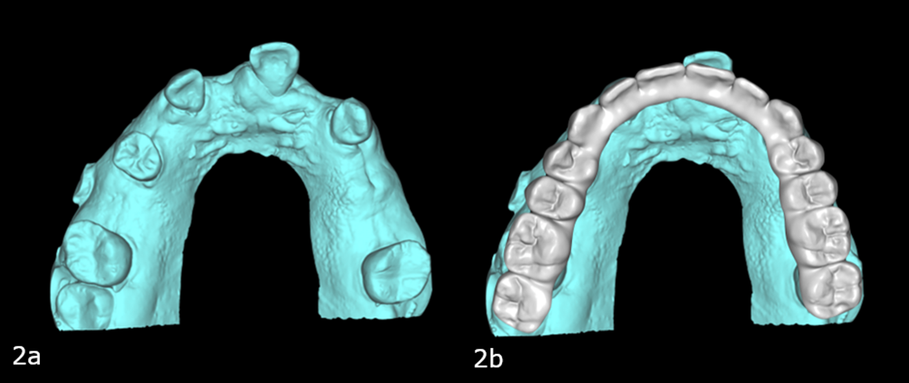 Figs. 2a & b: Pre-op maxillary intra-oral scan (a). Pre-op scan with the digital wax-up (b).