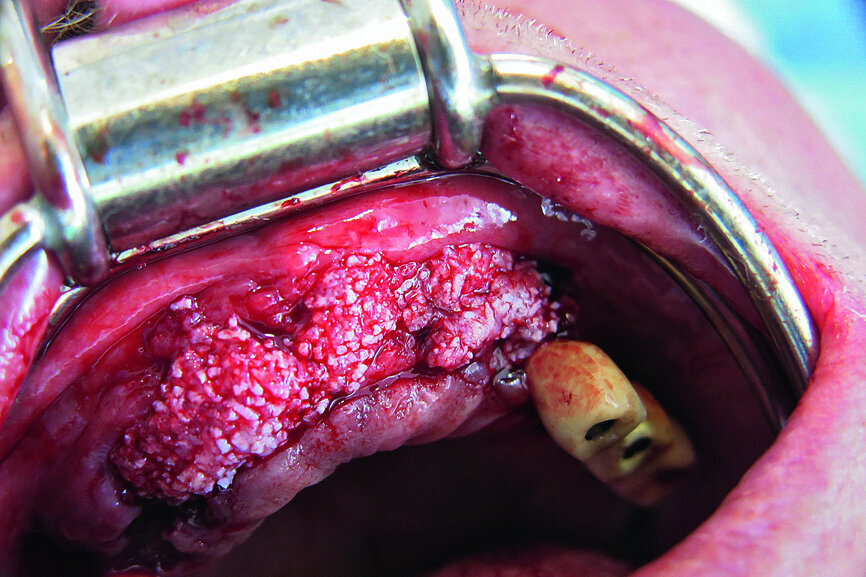 Fig. 10: 3-D augmentation using NanoBone.