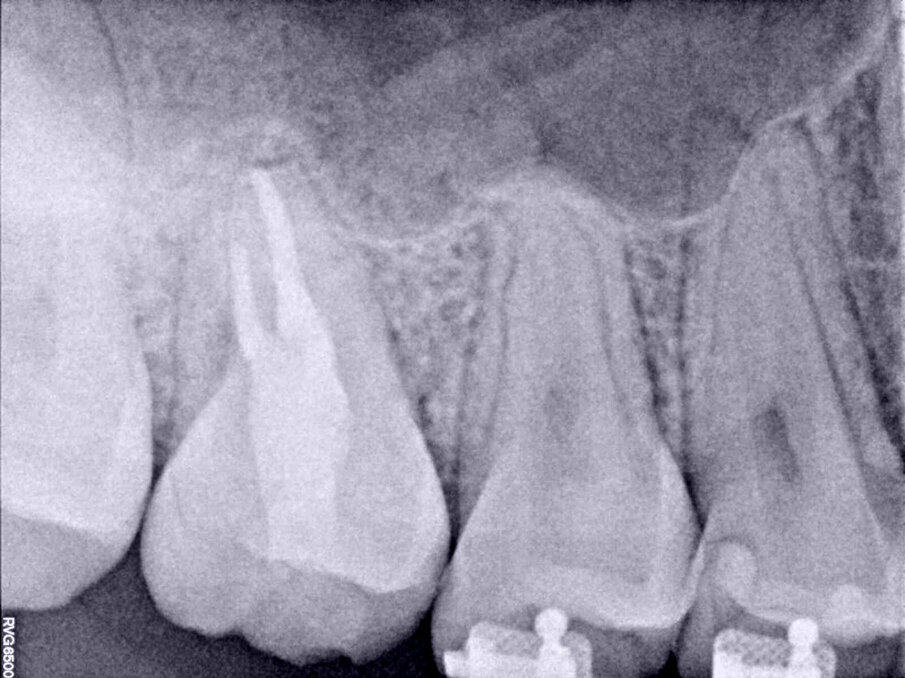 Fig. 11: Three-year follow-up radiograph. The periapical area had healed.