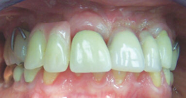 Implant fracture: A look at the physical mechanisms for failure