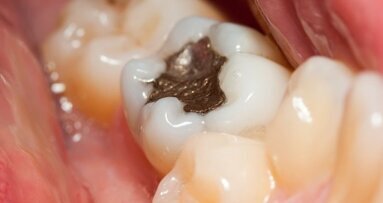 Preocupações relativas a materiais de preenchimento devido à alta incidência de cáries na Índia