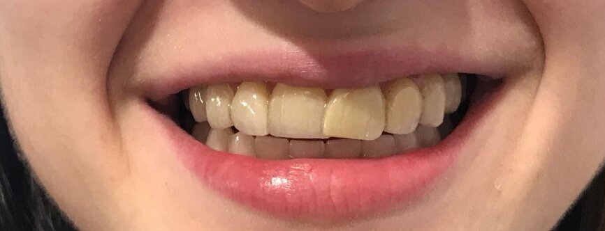 Agnese Graziani's teeth after.