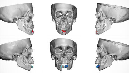 Jaw-in-a-day surgery successfully performed for the first time in Alabama