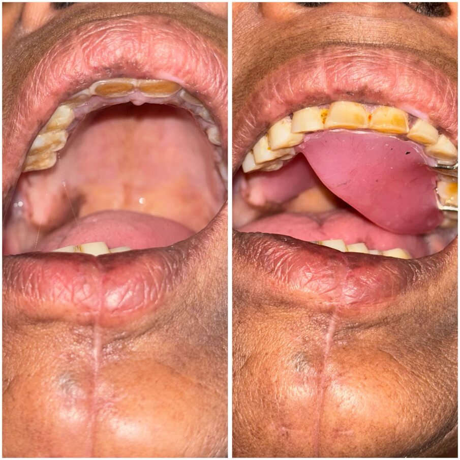Palatal Ramp 