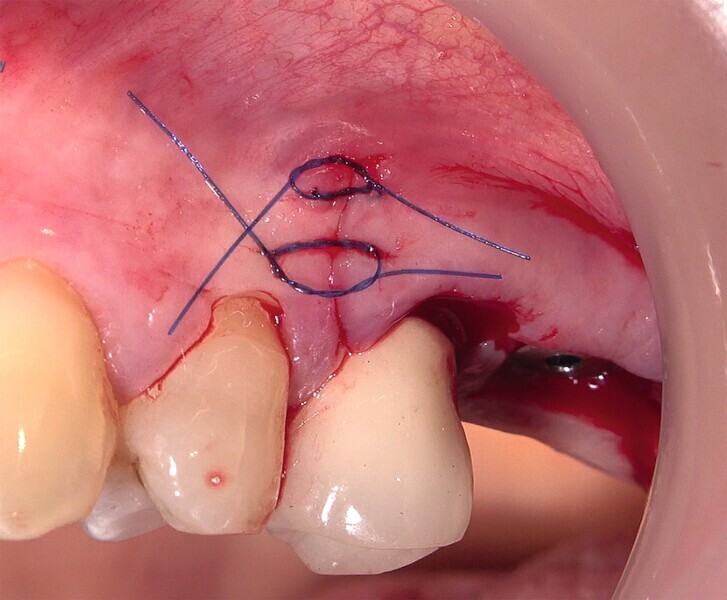 Fig. 42 : Microsutures. 