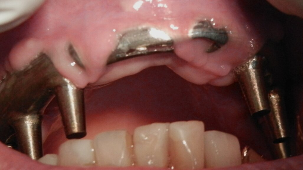 Regeneración Tisular Guiada con Barreras Oclusivas confeccionadas por CAD-CAM