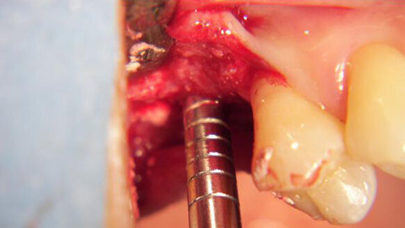 Piccolo rialzo del seno mascellare con innesto di biomateriale