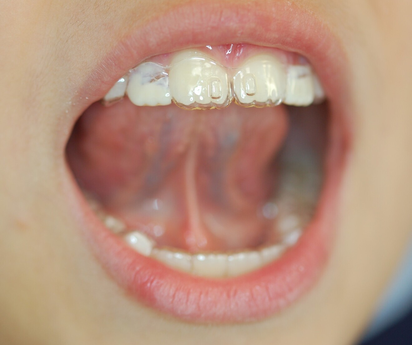 Fig. 6: Patient raising the tongue to touch the lingual stimuli (the eruption guides for teeth #12 and 22 can be observed, coloured as the patient wished).