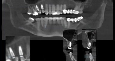 Colocación de implantes con LOCimplant System