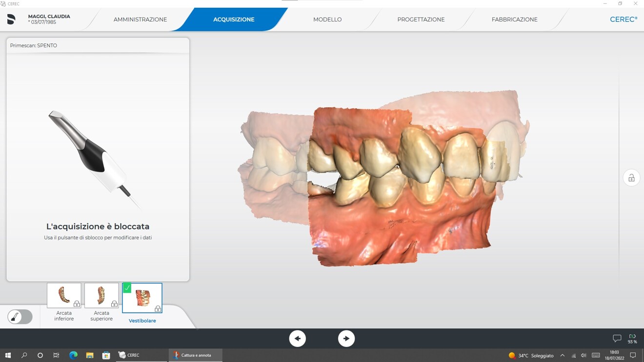 Fig. 4c: Intra-oral scan of buccal scan of the occlusal relationship.