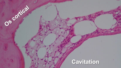 Échographie transalvéolaire dans le diagnostic des lésions inflammatoires de l’os