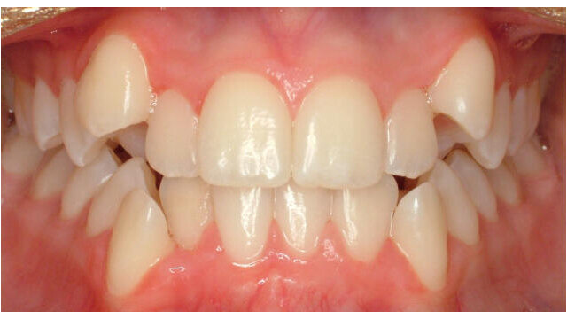 Why Dental Crowding Happens?