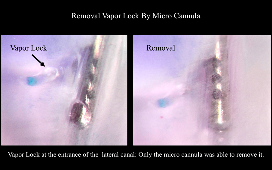 Slika 1b- Sleiman-Iandolo test. Pokazuje uklanjanje zaostalog mehurića vazduha upotrebom uređaja sa negativnim pritiskom.(Ostala sredstva kao ultrazvucna irigacija ili korišćenje lateralne igle nisu bila efikasna u uklanjanju zaostalog vazduha u kanalu pa je on ostajao na mestu)                                   Uklanjanje vazdušnog mehurića uz pomoć mikro kanile                     Vazdušni mehurić na ulazu u lateralni kanal: samo je mikrokanila uspela da ga ukloni