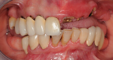 Oltre lo Smile Design. Cefalometria 3D per la  progettazione implanto-protesica