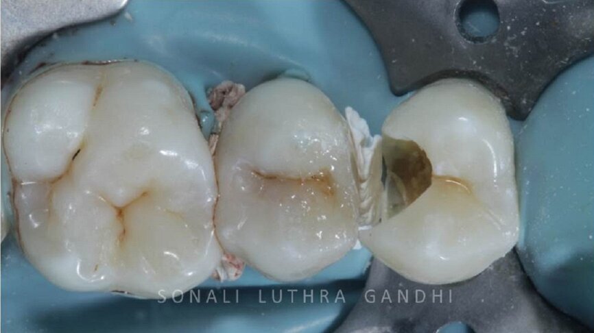 Figure 10 Band system removed,
Finished and polished
