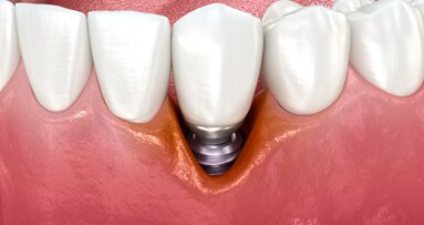 Particules de titane associées à l’échec des antibiotiques dans la péri-implantite