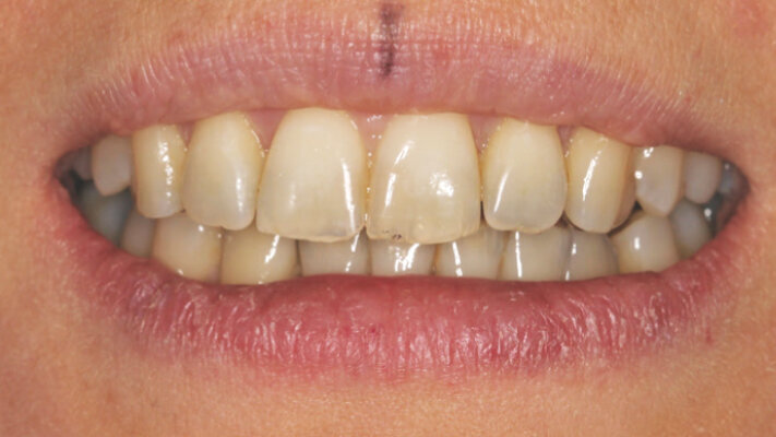 Lingvální zámky 3M™ Incognito™ System a kombinovaná ortodontickochirurgická terapie