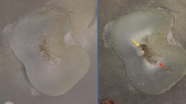 Dentine thickness in buccal roots of maxillary first premolars following preparation with three techniques