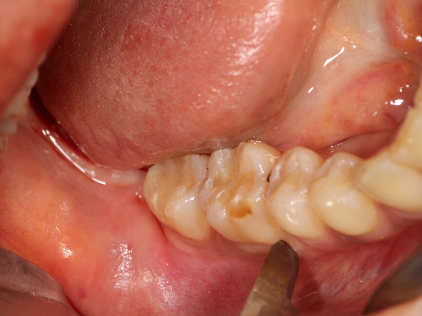 Fig. 5: A vertical releasing incision is made between the first molar and second premolar in the area to be flapped for donor site development in the right posterior mandible.