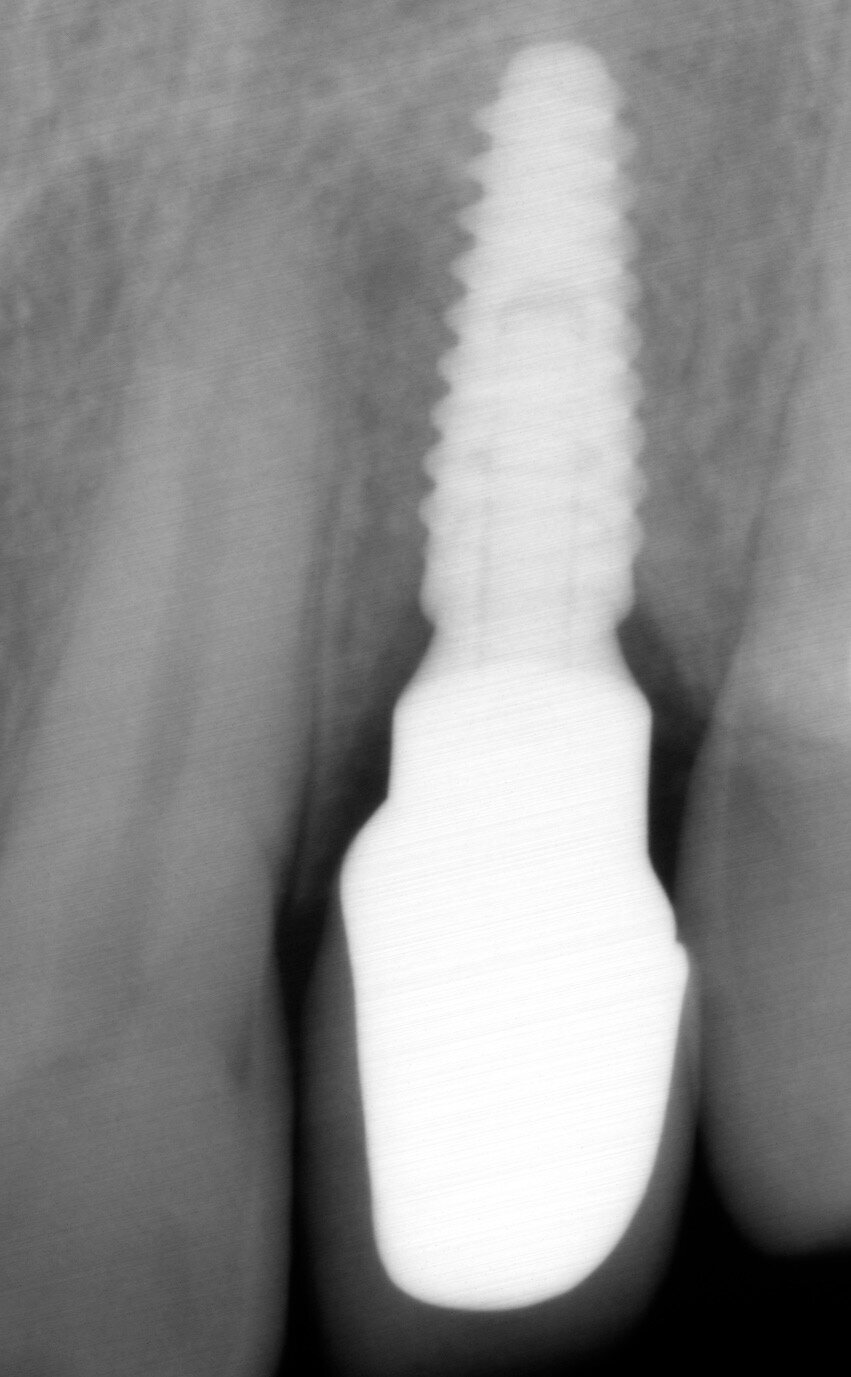 Fig. 11: Periapical radiograph taken five months after placement of the definitive restoration. Note the amount of peri-implant marginal bone that was preserved. 