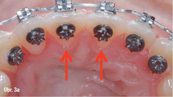 Doporučené umístění TS2 – o trochu více gingiválně u horních řezáků