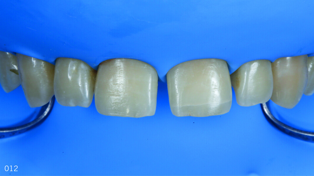Fig. 11: Isolation of the operative field using a dental dam, frontal view.