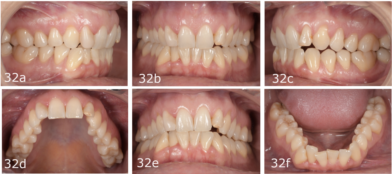 Figs. 32a–f: Pretreatment intra-oral photographs.