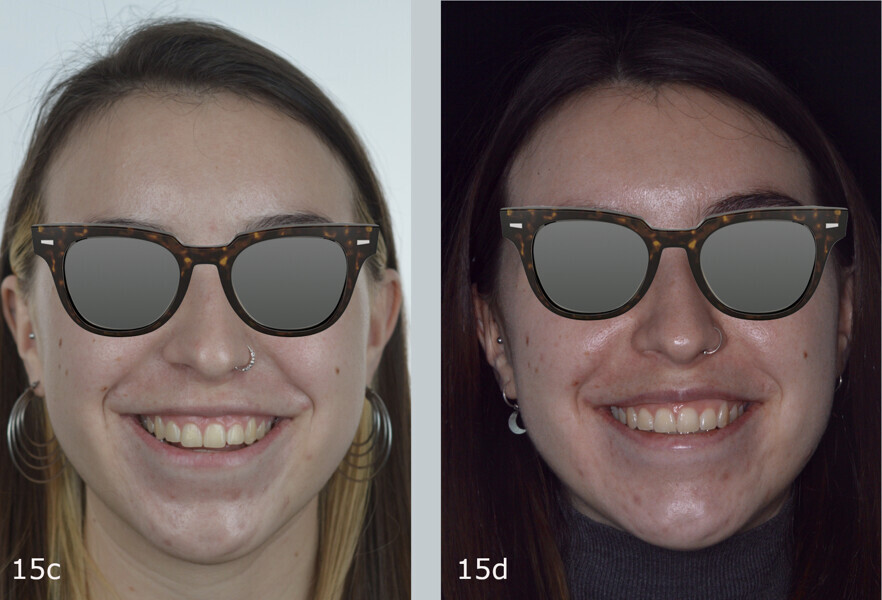 Figs. 15a–f: Extra-oral comparison of the situation (a, c & e) before and (b, d & f) after treatment. The mandibular deviation and the lower face height had been slightly corrected.