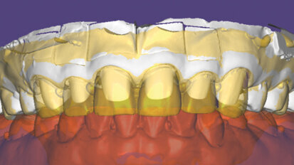 Zkratka po rychlé digitální dráze: Přesná reprodukce provizorních náhrad s IPS e.max Press® Multi
