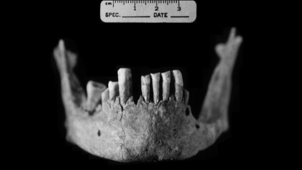 Ancient skeleton in India bears evidence of leprosy