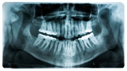 Analyse van tandheelkundige röntgenfoto’s door AI bespaart tijd in patiëntenzorg