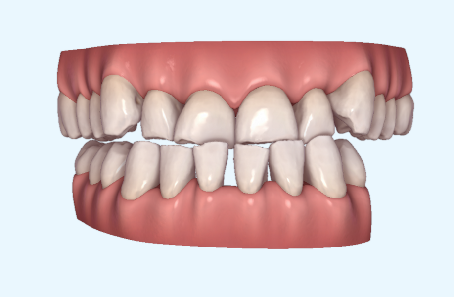 Figs. 18a–f: Invisalign ClinCheck treatment plan before and after frontal, lateral and inferior views