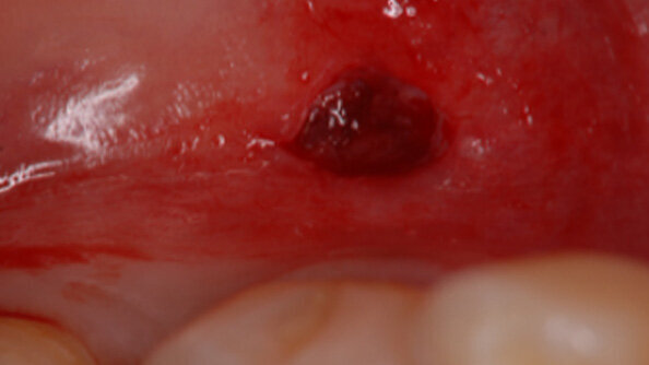 Accelerated generation of human induced pluripotent stem cells from human oral mucosa using episomal plasmid vectors and maternal transcription factor Glis1