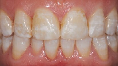 Remineralisatie: een preventieve en therapeutische benadering bij harde weefsels