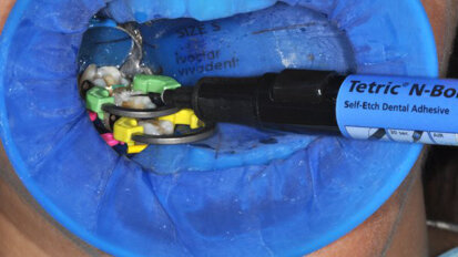 Las restauraciones en bloque, un cambio de paradigma