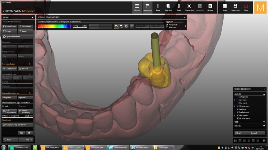 Fig. 6: Design of the CAD/CAM crown.