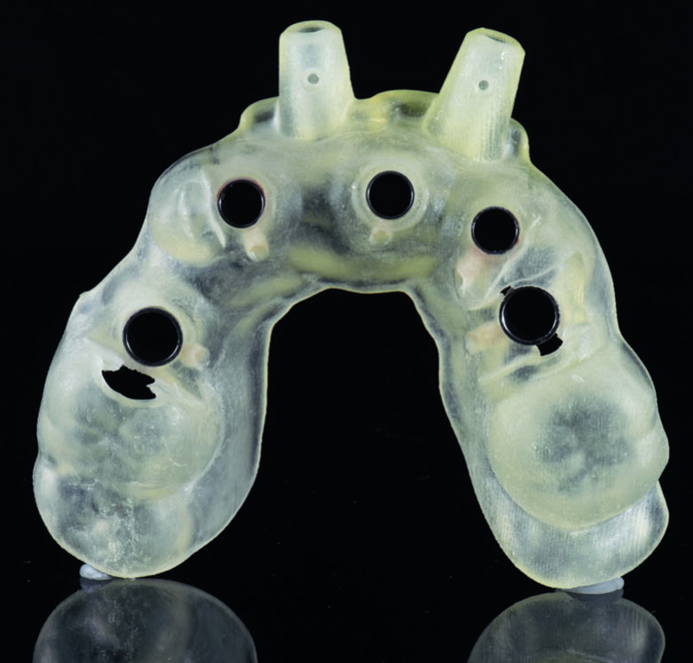 Fig 20. A Surgical guide with fully-guided sleeves