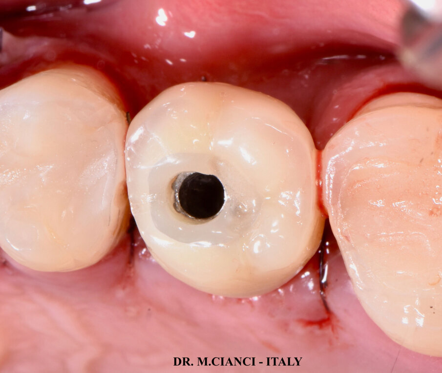 Fig. 11 - Provvisorio avvitato su transepiteliale unit.