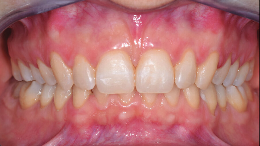 Figg. 8d-8f_Foto intraorali di fine trattamento.