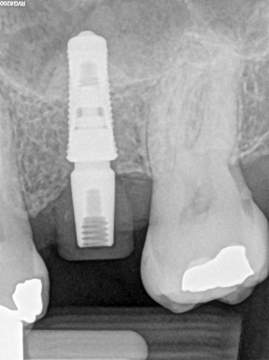 Fig. 6_Radiografia post-operatoria.