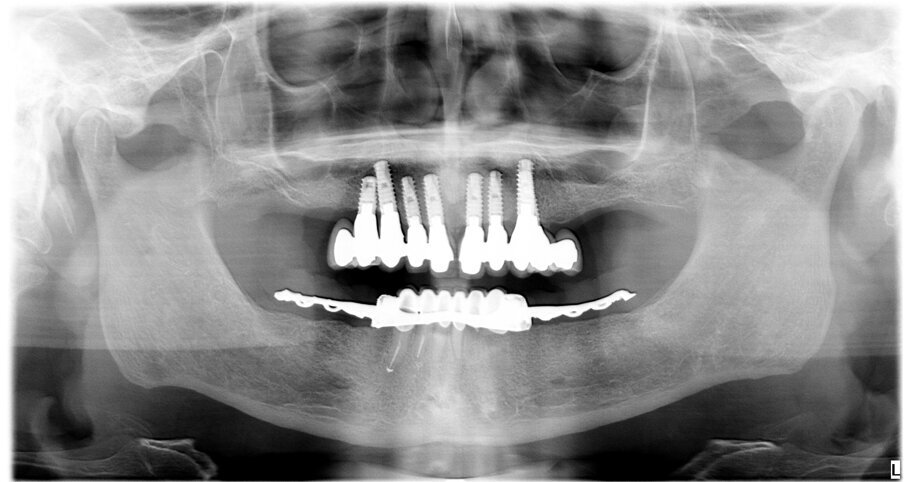 Fig. 1 - Rx iniziale.