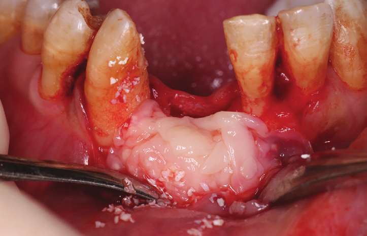 Figure 7: First layer of L-PRF membranes covering the associated xenograft-PRF (sticky bone) obtained that helped stabilizing the graft and insuring hemostasis.