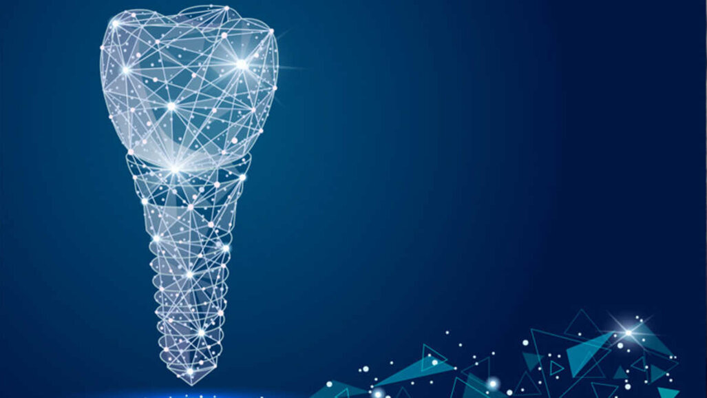 Implants individuels basés sur des procédures CAO/FAO