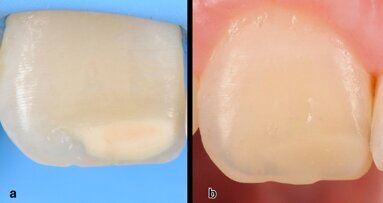 Infiltración de diente hipomineralizado reconstruido con resina compuesta