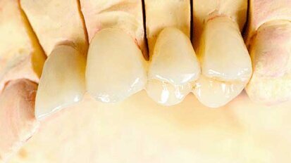 Study exploring accuracy of impression techniques finds partial vs. complete edentulism may be a confounding factor Study exploring accuracy of impression techniques finds partial vs. complete edentulism may be a confounding factor