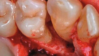 Zastosowanie laserów w ubytkach kostnych w obrębie przyzębia