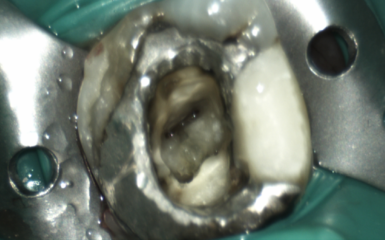 Fig. 2: Access to the pulp chamber showing four canals.