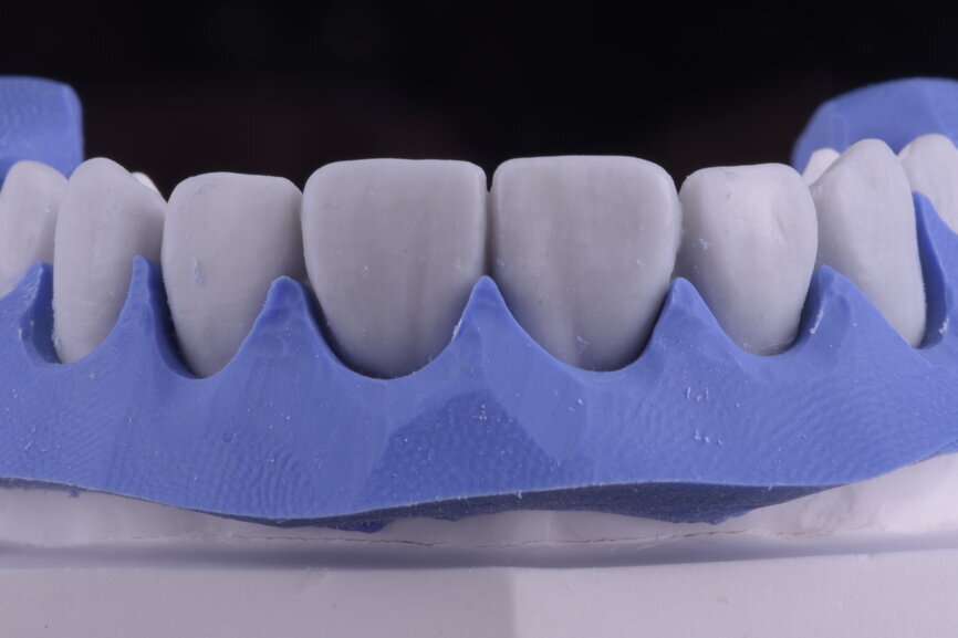 Fig. 42: Surgical silicone index for crown lengthening and cervical contours marked with a red pencil.