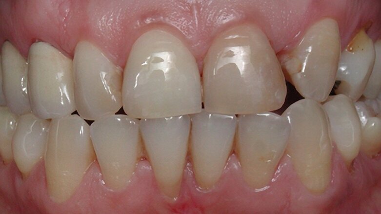 Rehabilitación bucal estética con asistencia de ortodoncia