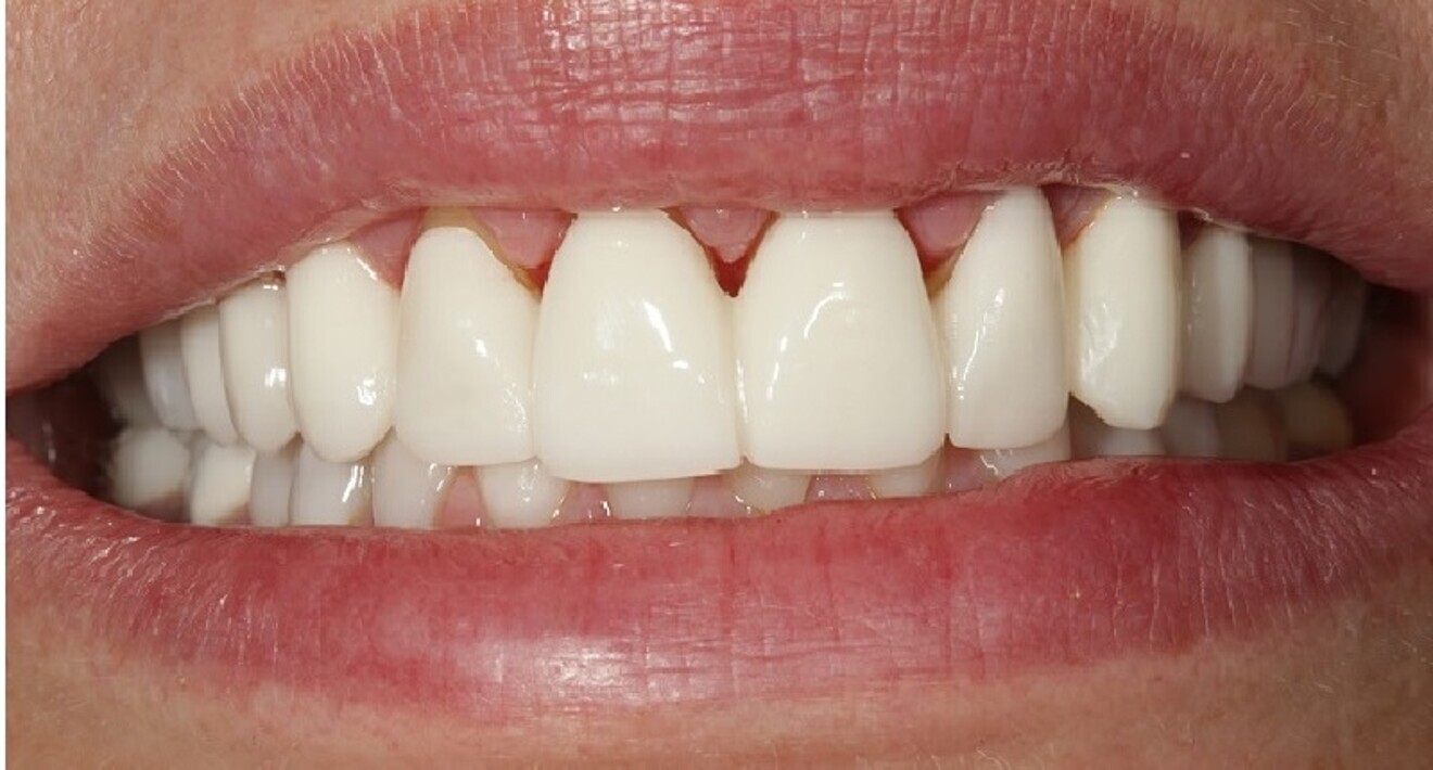 Fig. 11: First PMMA prototype in place. The margin on tooth #12 of the prototype had been trimmed short of the margin in the laboratory during nishing.